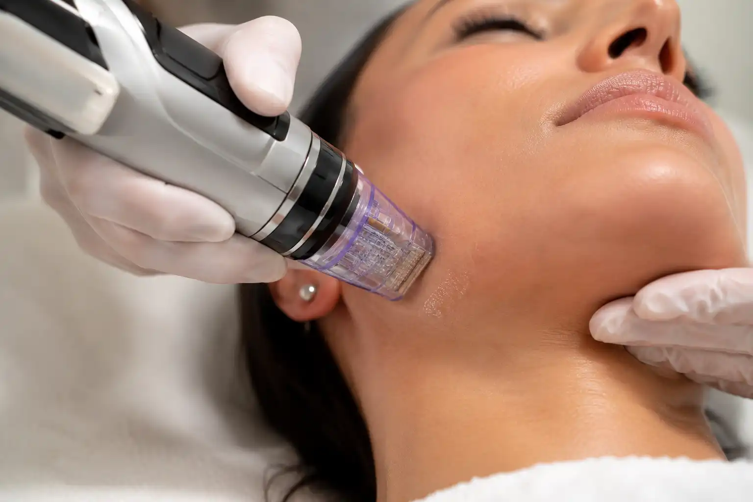 RF Microneedling